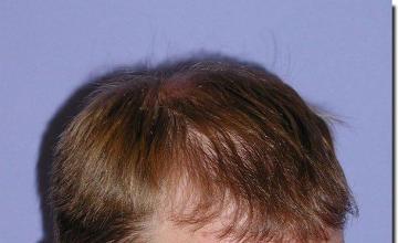 Hair restoration procedure results