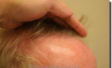 Hair restoration procedure results