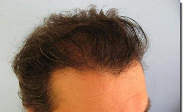 Hair restoration procedure results