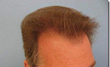 Hair restoration procedure results