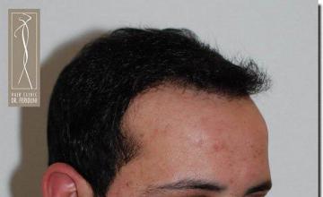 Hair restoration procedure results