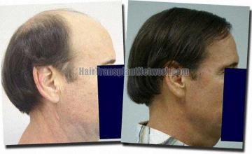 Hair restoration procedure results