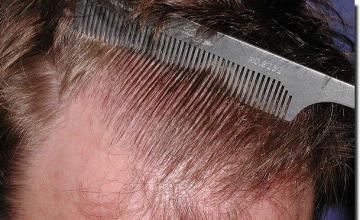 Hair restoration procedure results