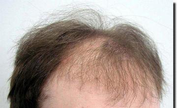 Hair restoration procedure results
