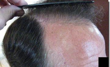 Hair restoration procedure results