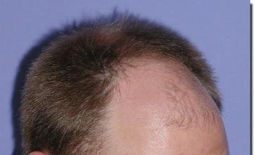 Hair restoration procedure results