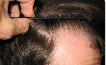 Hair restoration procedure results