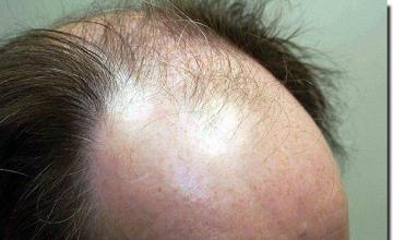 Hair restoration procedure results