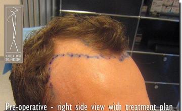 Hair restoration procedure results