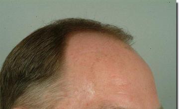 Hair restoration procedure results