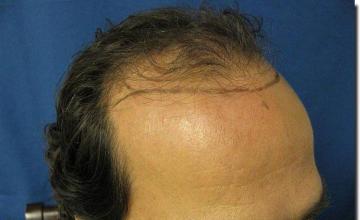 Hair restoration procedure results