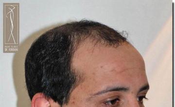 Hair restoration procedure results