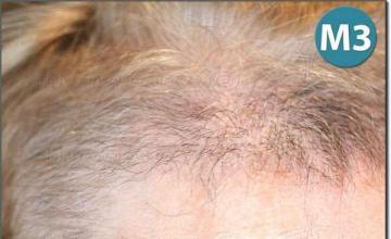 Hair restoration procedure results