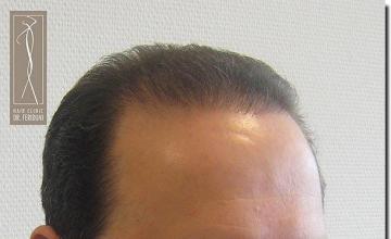 Hair restoration procedure results