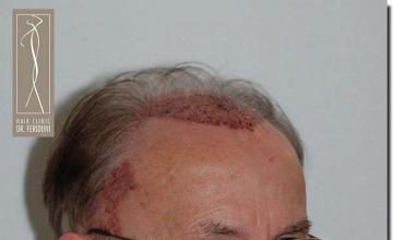 Hair restoration procedure results