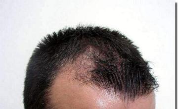 Hair restoration procedure results