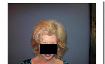 Hair restoration procedure results