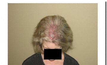 Hair restoration procedure results