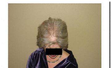 Hair restoration procedure results