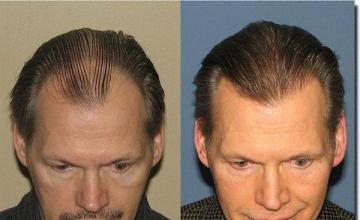 Hair restoration procedure results