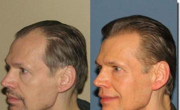 Hair restoration procedure results