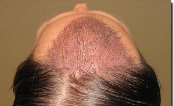 Hair restoration procedure results