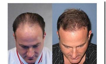 Hair restoration procedure results