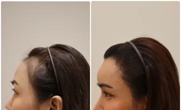 Before and After