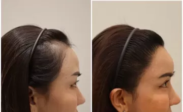 Before and After Side View