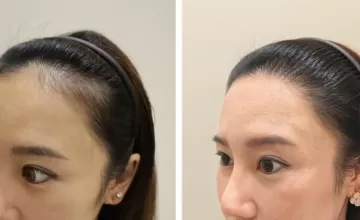 Before and After