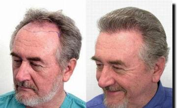 Hair restoration procedure results