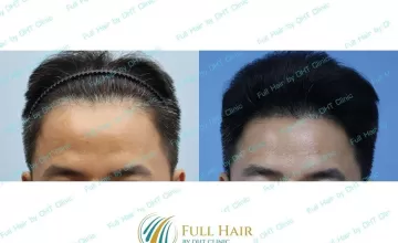Hairline