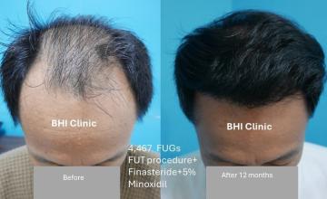 Diffuse Hair Loss Before and After