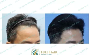 Before and After