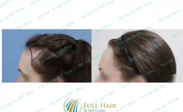 Before and After