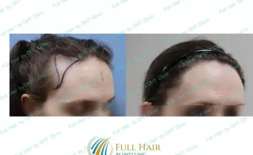Before and After Side View