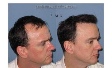 Before and after surgical hair restoration procedure