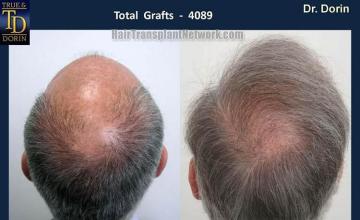 Before and after photos of hair transplant procedure