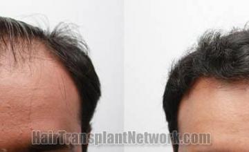 Images of hair transplantation results