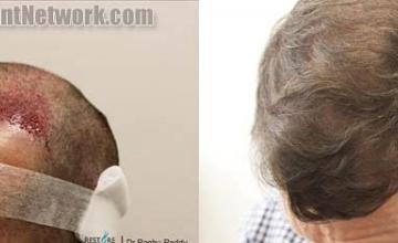 Hair transplantation surgery before and after images