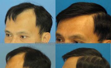 Surgical hair replacement before and after images