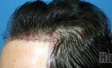 Left view - Before and after hair restoration procedure