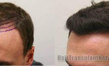 Hair transplantation surgery before and after pictures