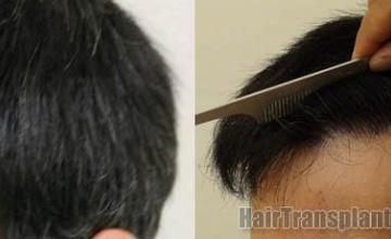 Left view before and after hair transplantation procedure