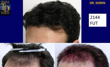 Hair replacement surgery before and after images