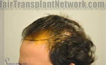 Before and after hair transplantation surgery results