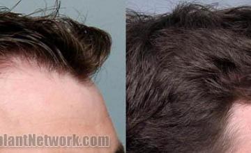 Hair restoration procedure before and after results