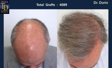 Top view - Before and after hair transplantation image