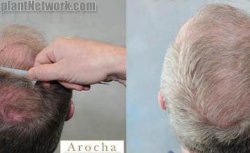 Before and after hair restoration procedure results