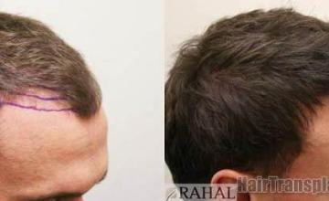 Hair restoration procedure results